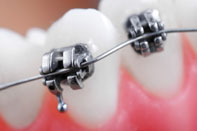 Aparat dentar fix metalic