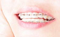 Aparat dentar fix ceramic